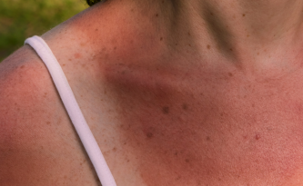 Come prendere il sole senza scottarsi
